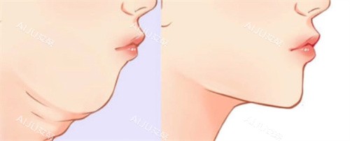 双下巴吸脂前后 双下巴吸脂前后