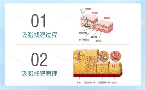吸脂减肥过程及原理 吸脂减肥过程及原理