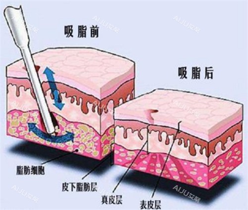 吸脂手术前后对比动画图示