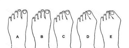 拇外翻程度 拇外翻程度