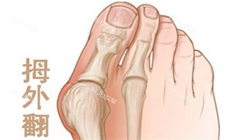 拇外翻 拇外翻