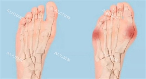 拇外翻对比 拇外翻对比