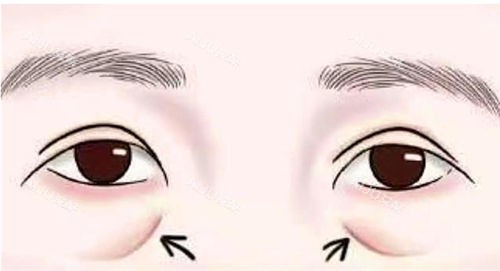 眼部泪沟标注动画展示图 眼部泪沟标注动画展示图