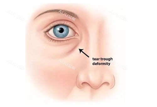 泪沟标注动画示意图 泪沟标注动画示意图