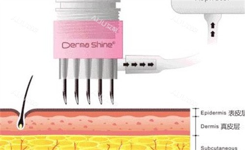 水光注射过程 水光注射过程