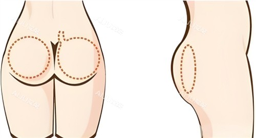 提臀手术臀部区域 提臀手术臀部区域