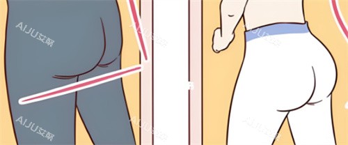 提臀手术前后对比 提臀手术前后对比