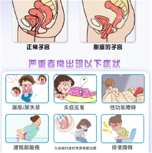 子宫脱垂的症状 子宫脱垂的症状