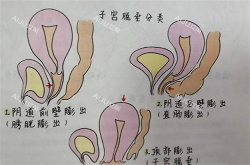 子宫脱垂的不同程度展现 子宫脱垂的不同程度展现