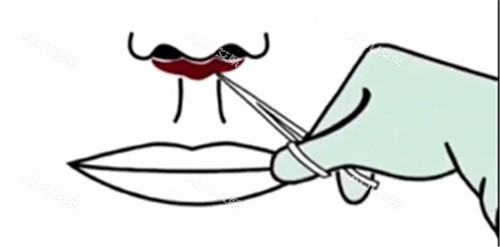 人中缩短手术动画图片 人中缩短手术动画图片