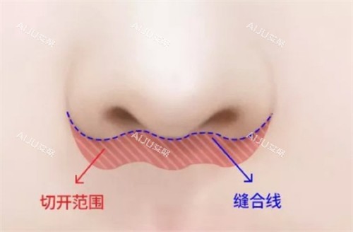 埋线人中缩短术手术位置图解 埋线人中缩短术手术位置图解