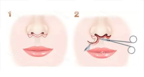 人中缩短术步骤过程 人中缩短术步骤过程