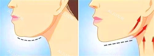 拉皮手术示意图 拉皮手术示意图