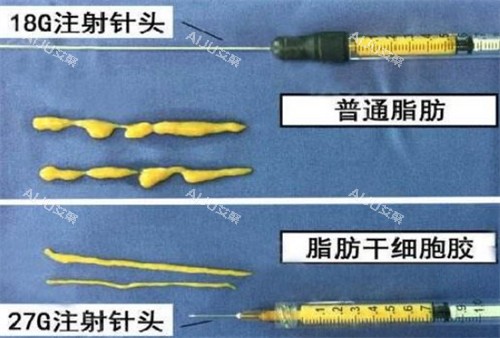 自体脂肪填充需要的脂肪提纯后的样子图片
