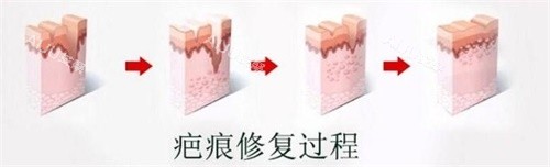 疤痕修复过程图