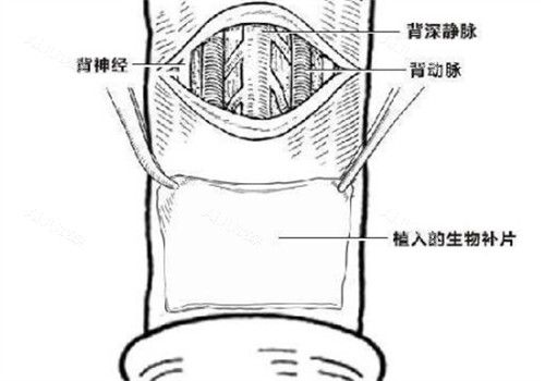 阴茎生物补片创口位置