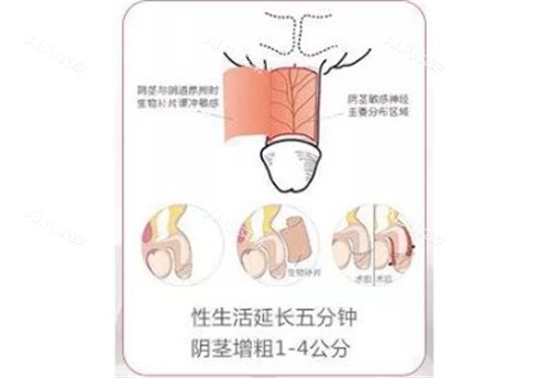 阴茎生物补片手术结果