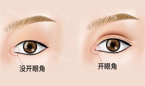 开眼角前后对比图 开眼角前后对比图