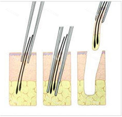 提取毛囊动画图 提取毛囊动画图