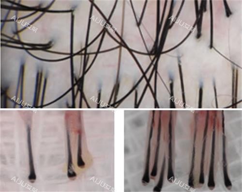 头皮放大毛囊细节图 头皮放大毛囊细节图