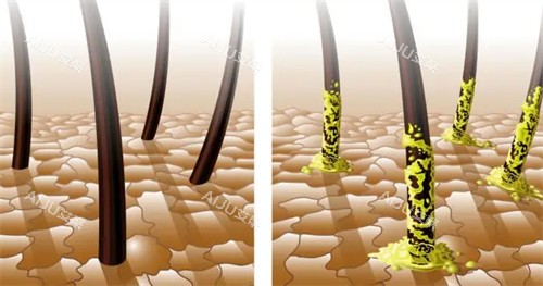 健康毛囊与脂溢性毛囊的区别对比图 健康毛囊与脂溢性毛囊的区别对比图