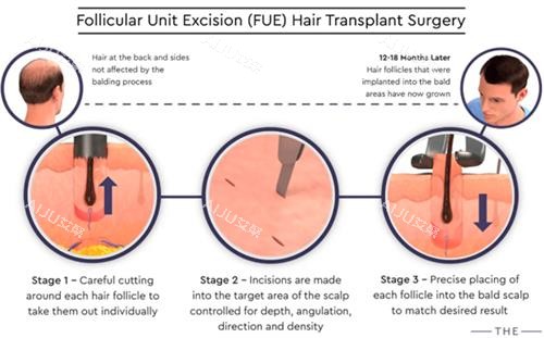 毛囊移植过程图解 毛囊移植过程图解