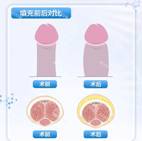 填充增大增粗示意图 填充增大增粗示意图