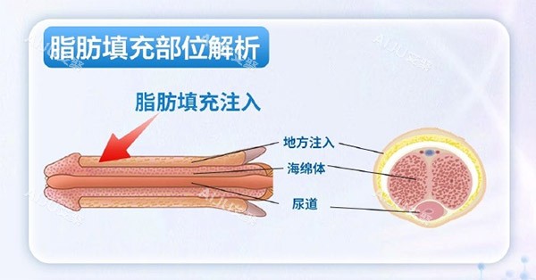 脂肪增大增粗照片 脂肪增大增粗照片