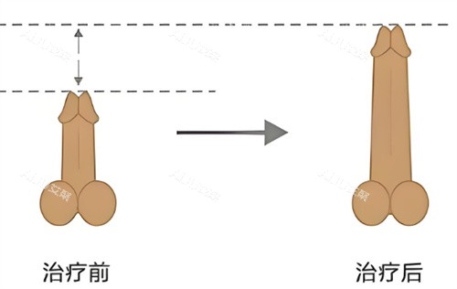 男生增大增粗示意图 男生增大增粗示意图