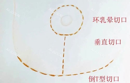 丰胸手术胸部下垂提升倒T字法 丰胸手术胸部下垂提升倒T字法