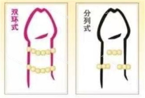 阴茎入珠术款式有哪些 阴茎入珠术款式有哪些