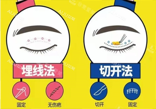 双眼皮埋线和切开对比图 双眼皮埋线和切开对比图