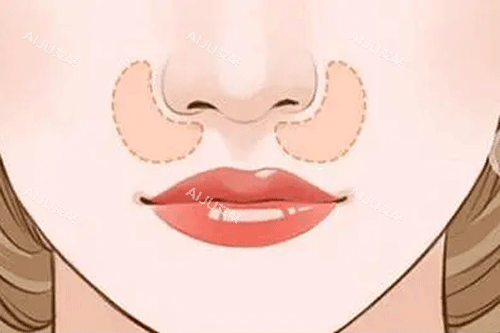 鼻基底凹陷动画图 鼻基底凹陷动画图