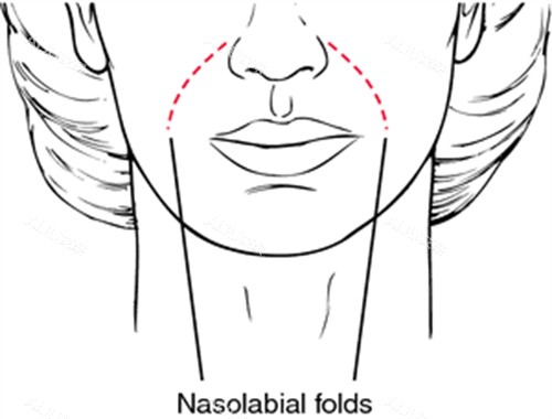 鼻基底凹陷看起来有法令纹 鼻基底凹陷看起来有法令纹