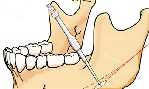 下颌角手术过程