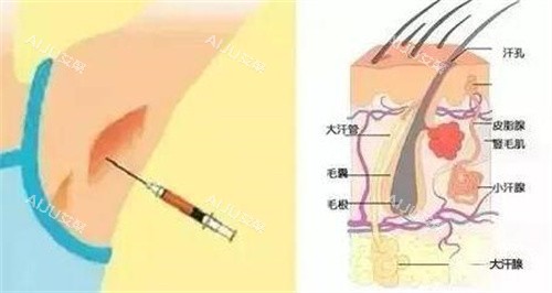 不手术去腋臭卡通图改善 不手术去腋臭卡通图改善