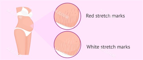 妊娠纹疤痕漫画图疤痕