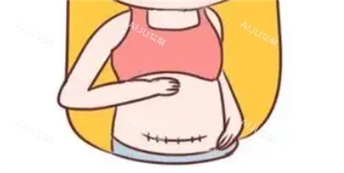 腹部疤痕