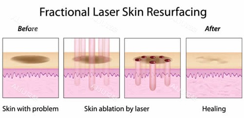 激光祛斑流程图 激光祛斑流程图