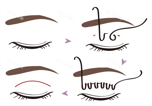 埋线双眼皮手术过程 埋线双眼皮手术过程