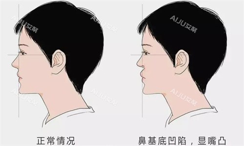 鼻基底凹陷填充