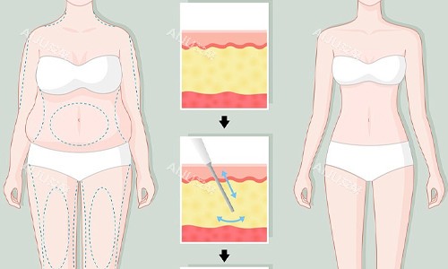 全身吸脂展示图