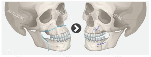 双颚手术的前后对比 双颚手术的前后对比