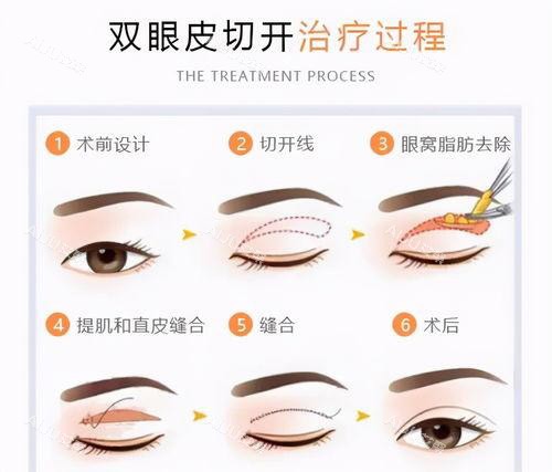 双眼皮手术方法过程图 双眼皮手术方法过程图