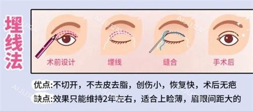 双眼皮手术埋线法动画演示图 双眼皮手术埋线法动画演示图