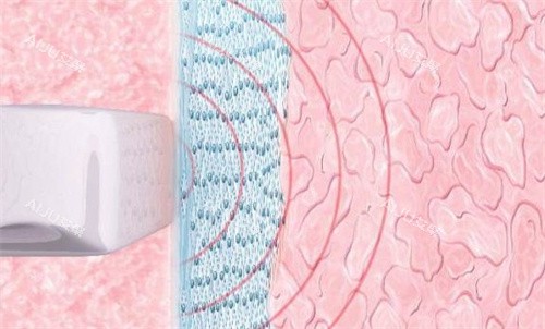 阴道紧缩原理 阴道紧缩原理