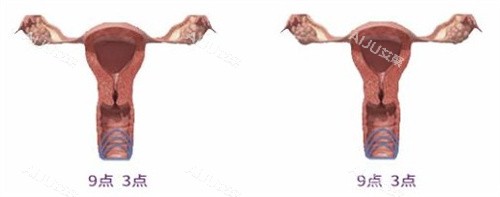 阴道紧缩手术 阴道紧缩手术