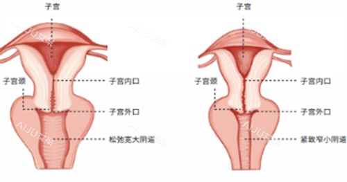 阴道紧缩术施术位置图解 阴道紧缩术施术位置图解