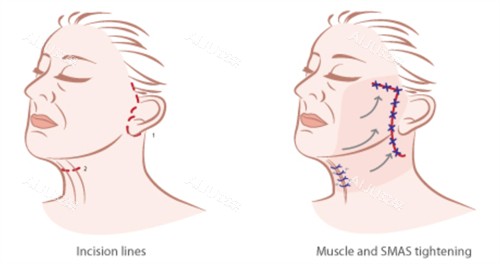 面部提升手术的对比和切口