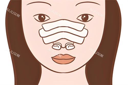 隆鼻修复术后图